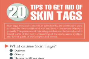 Effective ways on how to get rid of skin tags